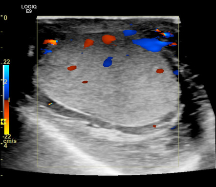 Segmental testicular infarction following epididymo-orchitis | Image ...