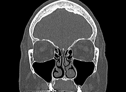 Normal CT paranasal sinuses | Radiology Case | Radiopaedia.org