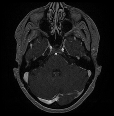 Facial nerve schwannoma | Radiology Reference Article | Radiopaedia.org