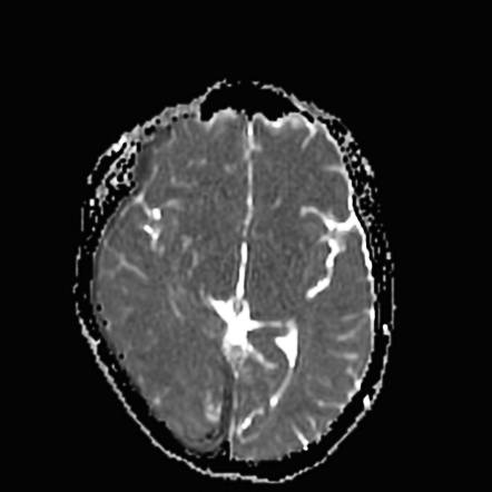 Cerebral arteriovenous malformation with subdural hematoma | Image ...