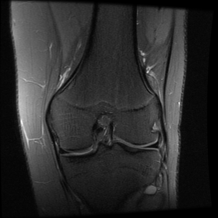 Jumper's knee, osteochondral injury, and excessive lateral pressure ...