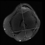 Patellar translation (TT-TG distance) | Radiology Reference Article ...