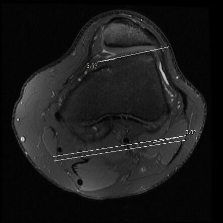 Lateral Trochlear Inclination 