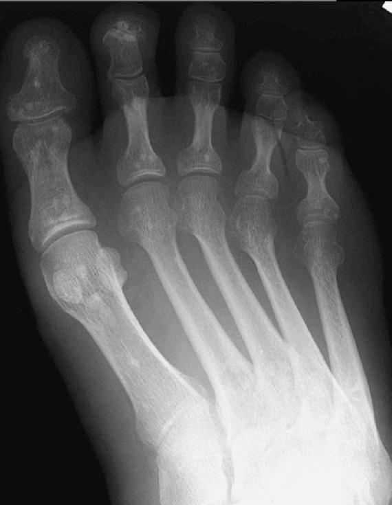 Osteopoikilosis | Image | Radiopaedia.org