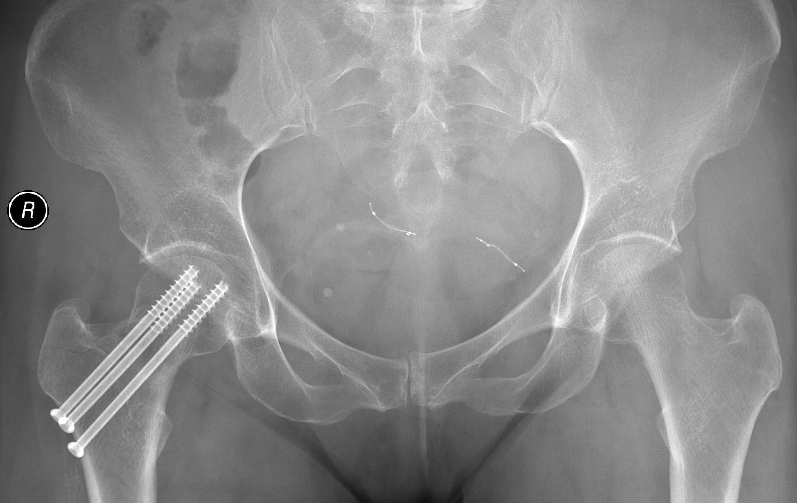 hip-stress-fracture-image-radiopaedia