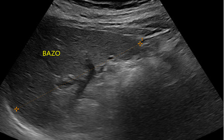 Splenic Artery Ultrasound