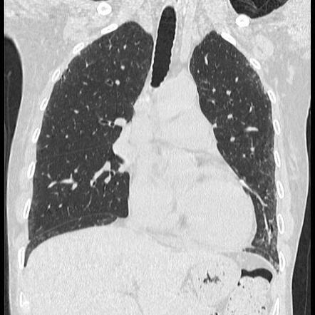 Systemic sclerosis and non-specific interstitial pneumonitis | Image ...