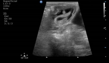 Intestinal ascariasis (ultrasound) | Radiology Case | Radiopaedia.org