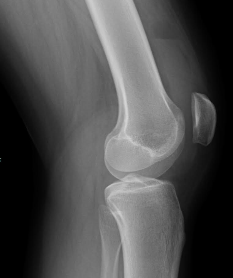 Knee lipohemarthrosis | Image | Radiopaedia.org