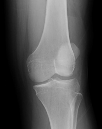 Knee lipohemarthrosis | Image | Radiopaedia.org