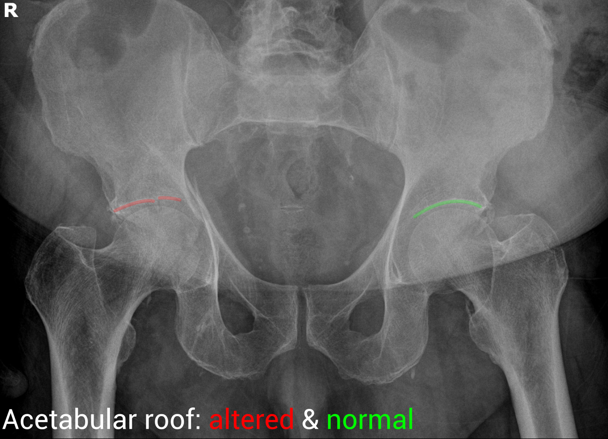 Esclerose Do Teto Acetabular - BRAINCP