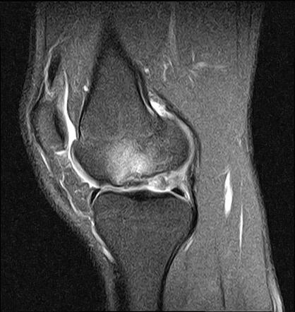 Osteochondritis dessicans - knee | Radiology Case | Radiopaedia.org