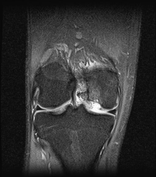 Osteochondritis dessicans - knee | Image | Radiopaedia.org