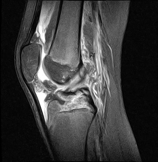 ACL Avulsion Fracture | Image | Radiopaedia.org