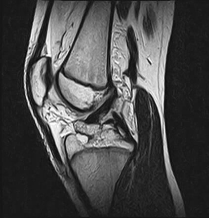 Acl Avulsion Fracture 