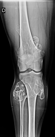 hereditary multiple exostoses case study