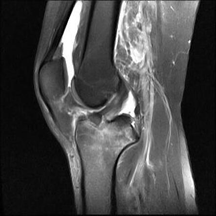 Concomitant complete tear of MCL and ACL avulsion fracture in right ...