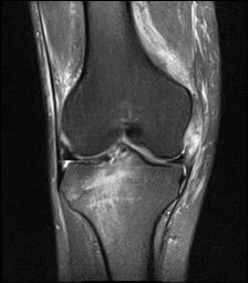 Concomitant complete tear of MCL and ACL avulsion fracture in right ...