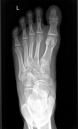 Cuboid fracture | Radiology Case | Radiopaedia.org