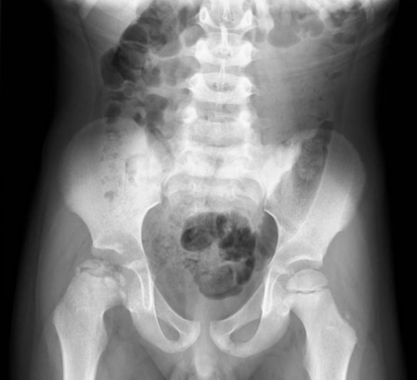 Perthes disease Image