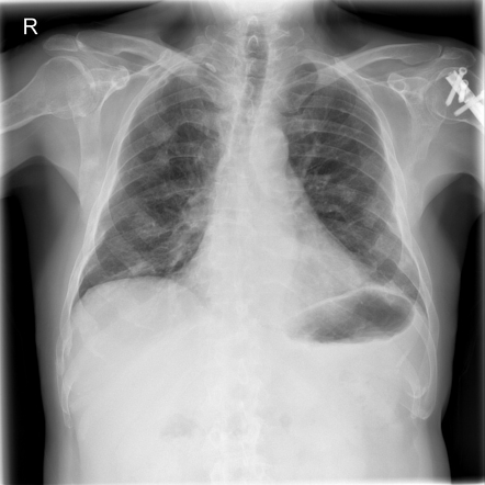 Left scapula lytic lesion - multiple myeloma | Radiology Case ...