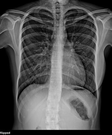 Pectus excavatum | Image | Radiopaedia.org