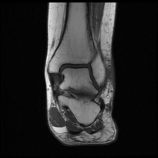 Haglund Syndrome - Bilateral 