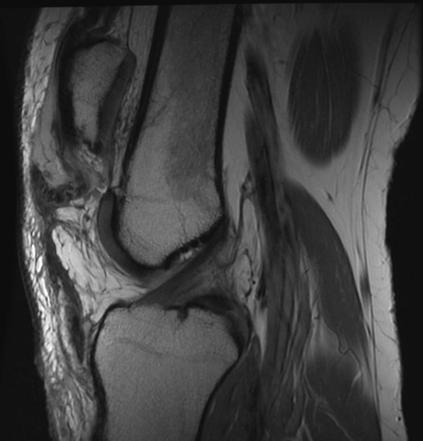 Patella alta | Radiology Reference Article | Radiopaedia.org