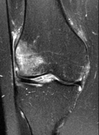 Patellar dislocation | Radiology Case | Radiopaedia.org