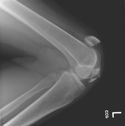 Patellar fracture | Radiology Case | Radiopaedia.org