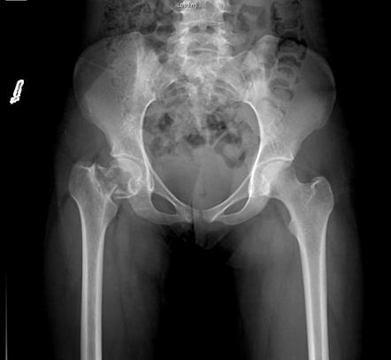 Pathological fracture | Radiology Case | Radiopaedia.org