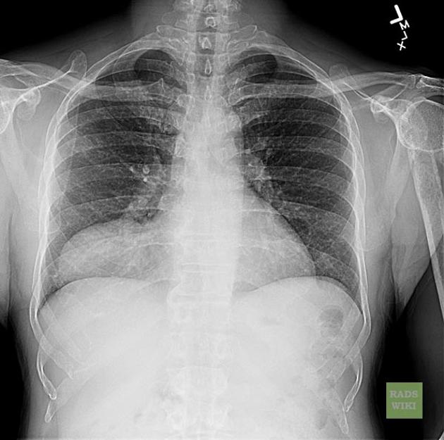 Image Diagnosis: Pericardial Cyst The Permanente Journal, 55% OFF