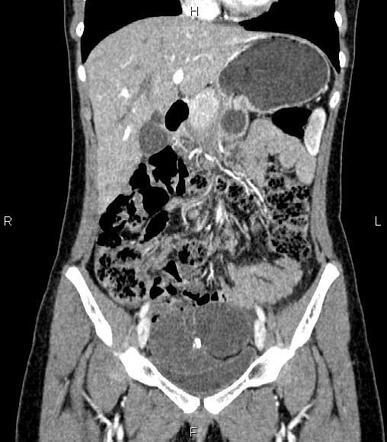 Mature cystic ovarian teratoma | Radiology Reference Article ...