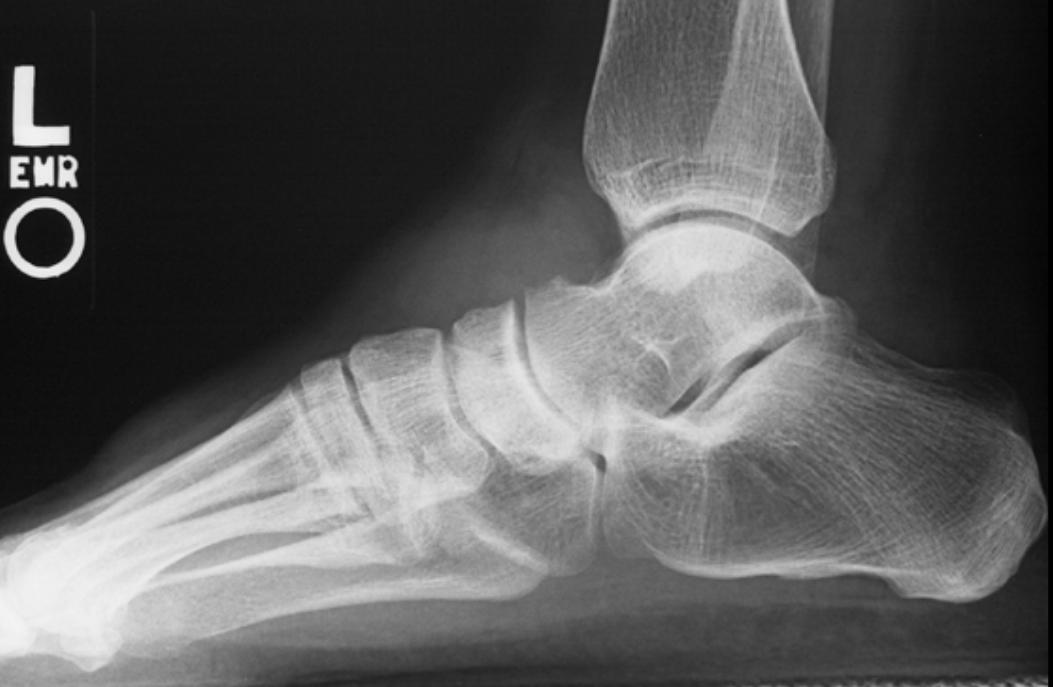 Pigmented villonodular synovitis - foot | Image | Radiopaedia.org