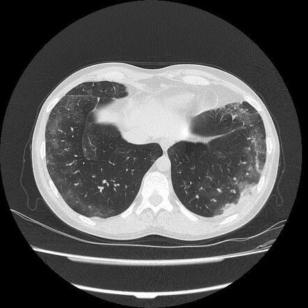 Eosinophilic granulomatosis with polyangitis | Radiology Case ...