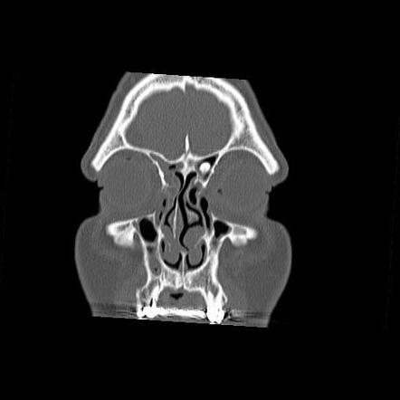 Frontal sinus osteoma | Image | Radiopaedia.org