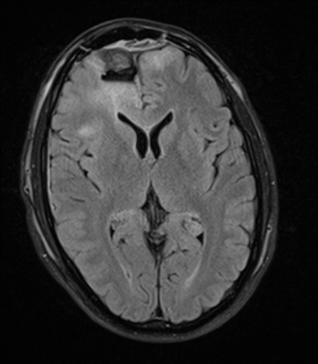 Glioblastoma with coagulative necrosis due to bevacizumab | Image ...