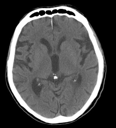 Pineal gland calcification | Radiology Case | Radiopaedia.org