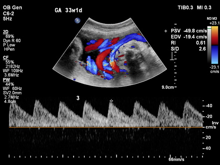 Triple loop nuchal cord | Image | Radiopaedia.org