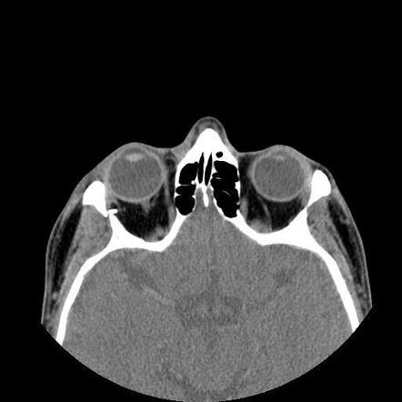 Lateral orbital wall blow-in fracture and concomitant orbital floor and ...