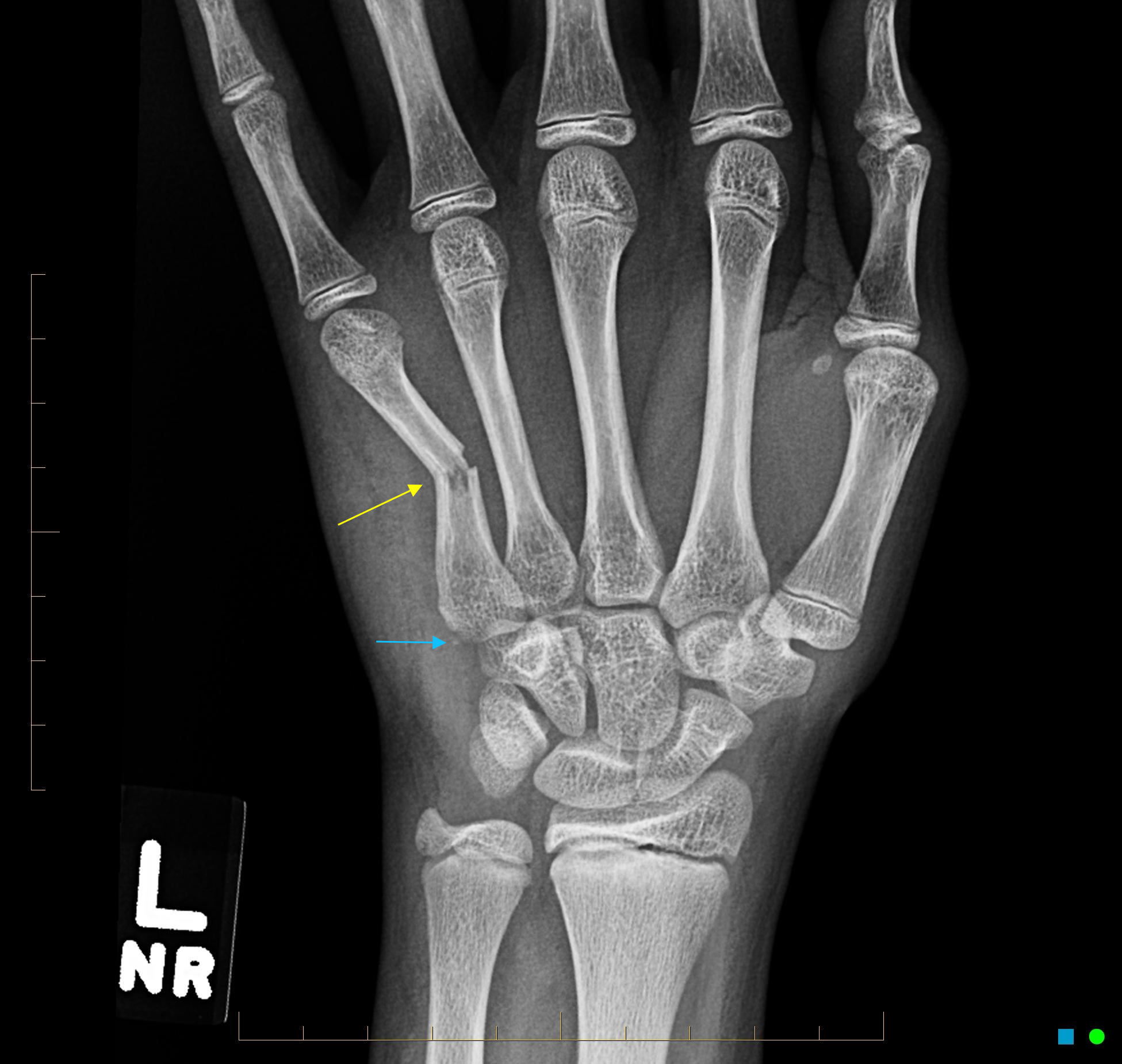 Greenstick fracture of the 5th metacarpal | Image | Radiopaedia.org