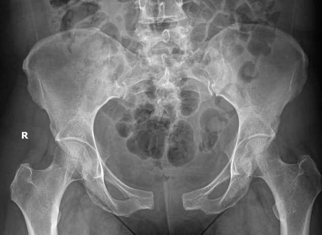 Open book pelvic injury, Radiology Reference Article