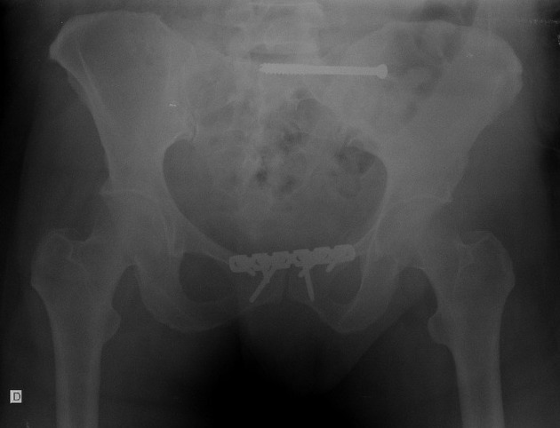 Open book pelvic injury, Radiology Reference Article