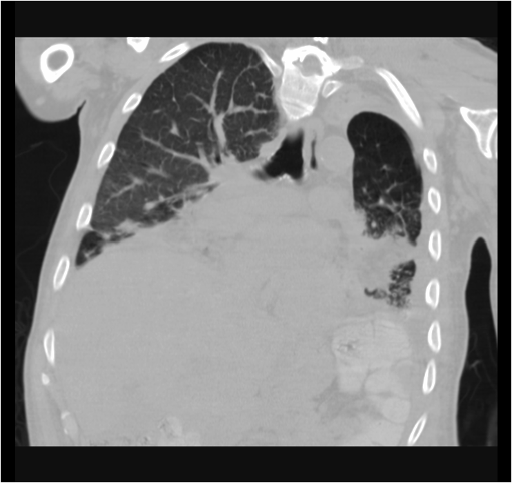 Lipoid Pneumonia Image