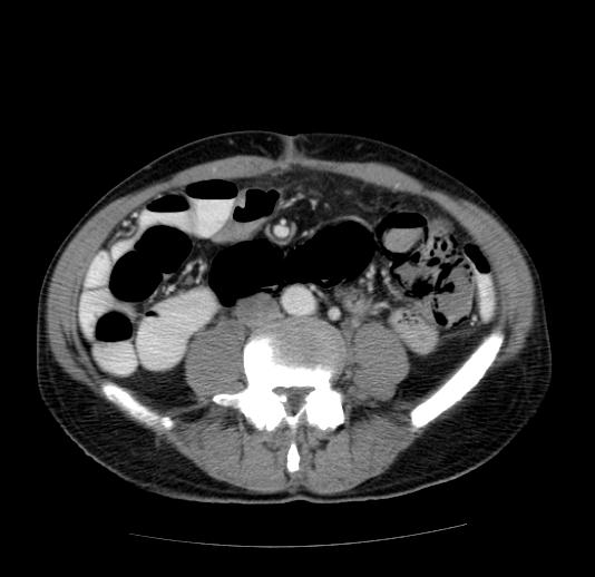 Pneumatosis intestinalis | Image | Radiopaedia.org