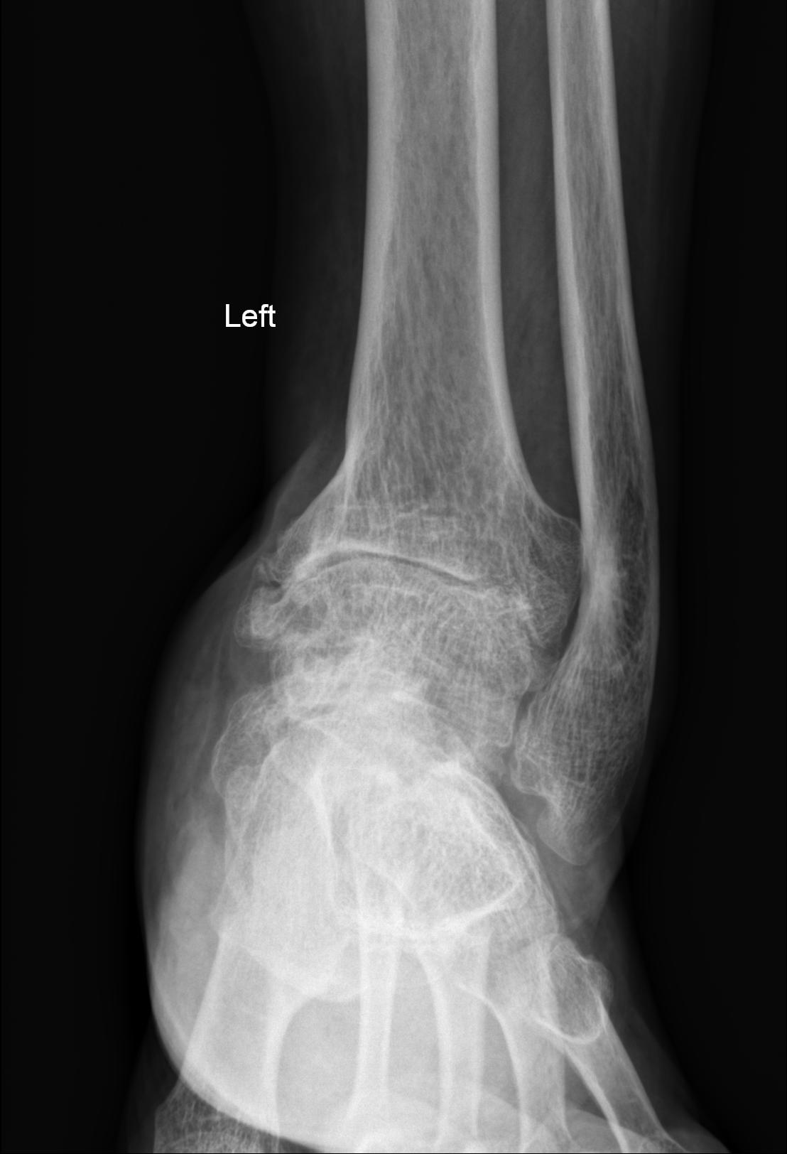 Severe osteoarthritis of the ankle Image