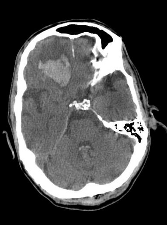 Orbital roof fracture and intracerebral hemorrhage | Radiology Case ...