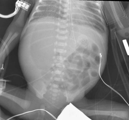 Pneumoperitoneum - neonate | Image | Radiopaedia.org