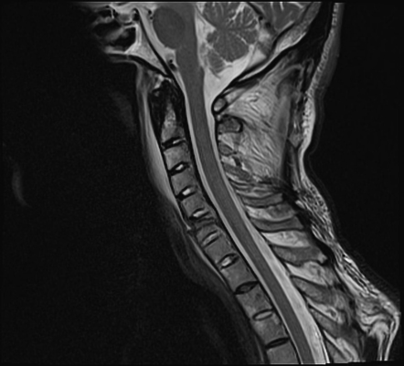 Chalk stick fracture - ankylosing spondylitis | Image | Radiopaedia.org