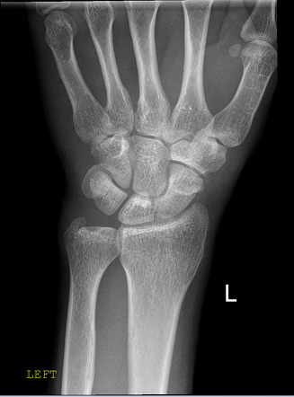 Scaphoid fracture | Radiology Case | Radiopaedia.org